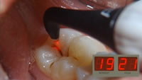 bezbolesne leczenie zębów